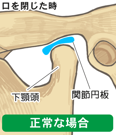 顎関節が正常な場合