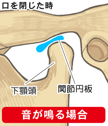 顎関節に音が鳴る場合