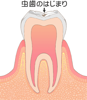 ユー歯科クリニック 虫歯のはじまり