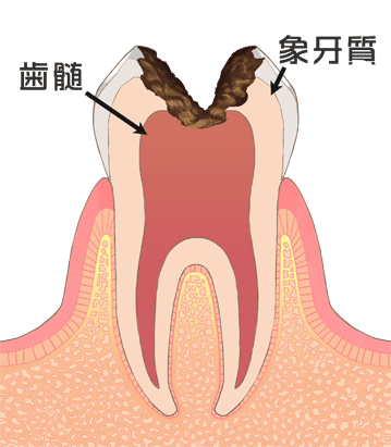 ユー歯科クリニック 大きな虫歯