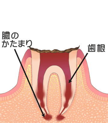 ユー歯科クリニック とても大きな虫歯