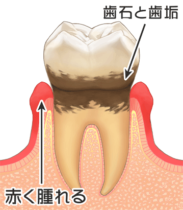 歯ぐきが腫れる