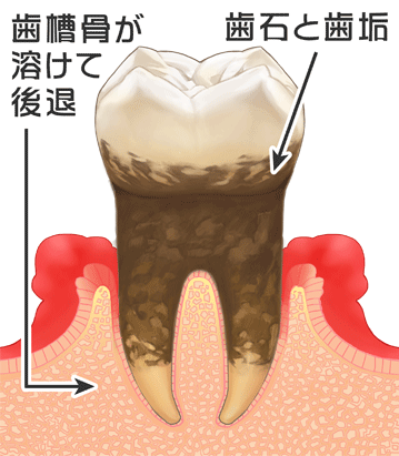 歯槽骨が溶ける